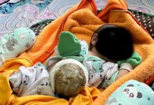 Bayi penderita kelainan usus di luar perut di Pandegalng. Foto Daeng Yusvin