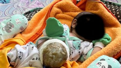 Bayi penderita kelainan usus di luar perut di Pandegalng. Foto Daeng Yusvin