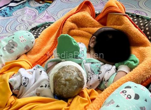 Bayi penderita kelainan usus di luar perut di Pandegalng. Foto Daeng Yusvin