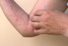 Penampakan penyakit Cacar Monyet. Foto: SehatNegeriku Kemkes