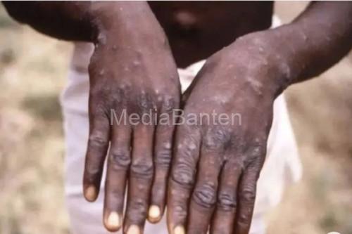 Cacar Monyet atau MonkeyPox. Foto: Antara