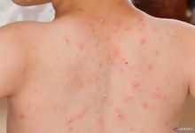 Campak Rubela. Foto: Antara