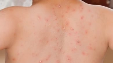 Campak Rubela. Foto: Antara