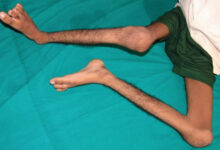 Ilustrasi pasien polio. Foto: Kemenkes RI