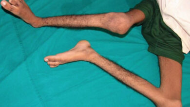 Ilustrasi pasien polio. Foto: Kemenkes RI