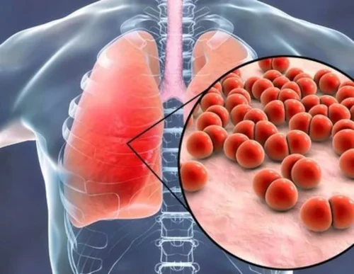 Infeksi radang paru-paru atau pneumonia. Foto: Istimewa