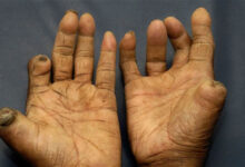 Efek penyakit kusta. Foto: Istimewa