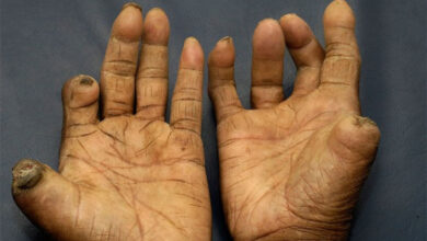 Efek penyakit kusta. Foto: Istimewa