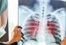 Ilustrasi penyakit tuberkulosis atau TB. Foto: RS Royal Progress