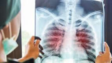 Ilustrasi penyakit tuberkulosis atau TB. Foto: RS Royal Progress