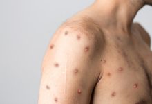 Penyakit cacat monyet atau monkeypox. Foto: Shutterstock