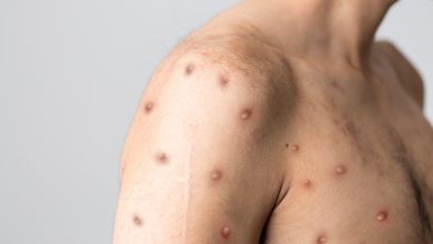 Penyakit cacat monyet atau monkeypox. Foto: Shutterstock