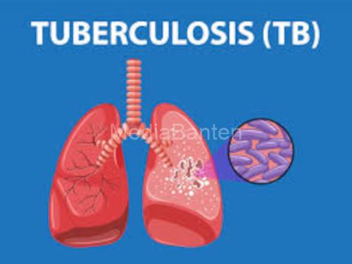 Ilustrasi TBC. Foto Istimewa