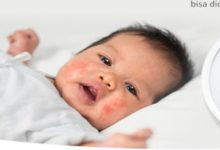 Penyakit sepsis pada anak atau balita. Foto: LKBN Antara